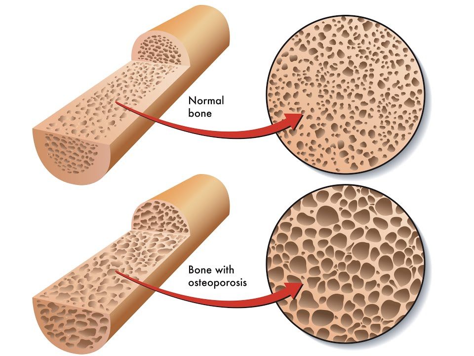 bone showing porous nature of bones in osteoporosis