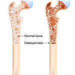 A diagram of healthy and osteoporotic bone